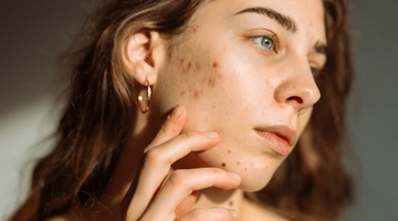 Ultimate Guide to Acne Management: Tips and Trends for Clearer Skin